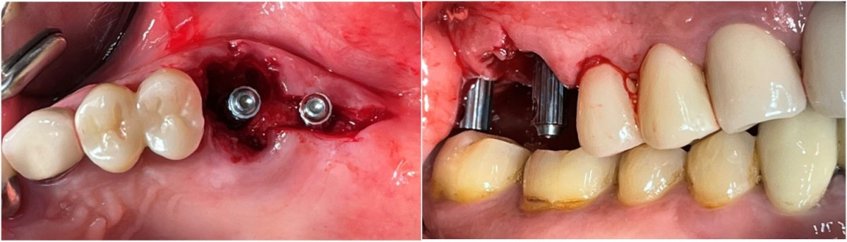 Direction pin engagement to verify the position and direction of the implant.