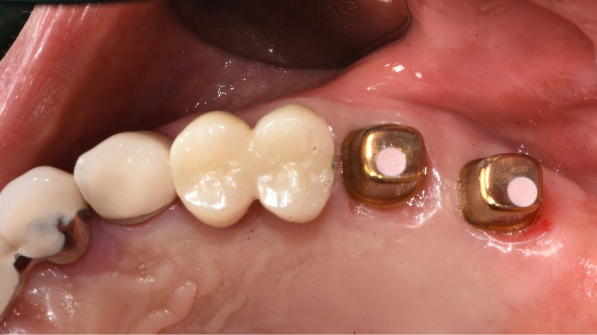 Abutment connection