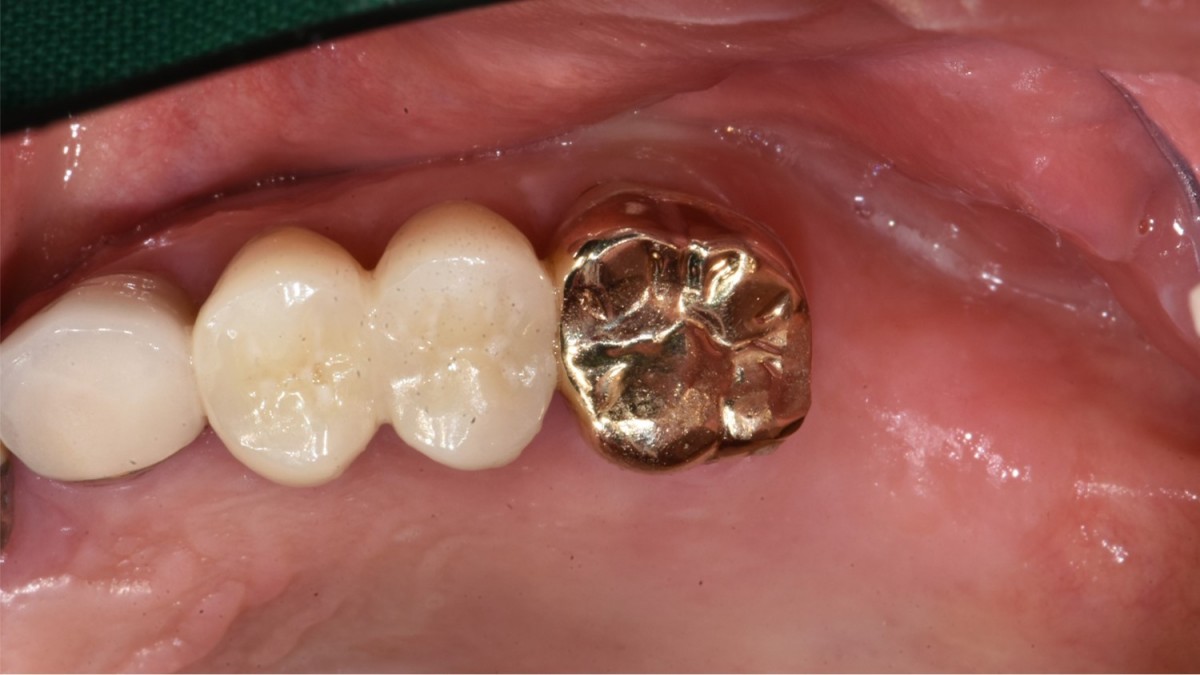  Pre-op panoramic radiograph (upper left molar area)