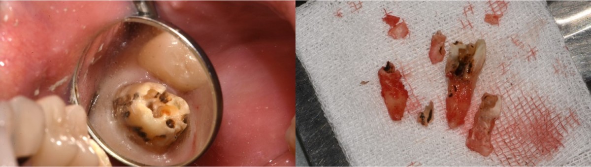 When the old crown was removed it seemed hopeless and surgical extraction was performed