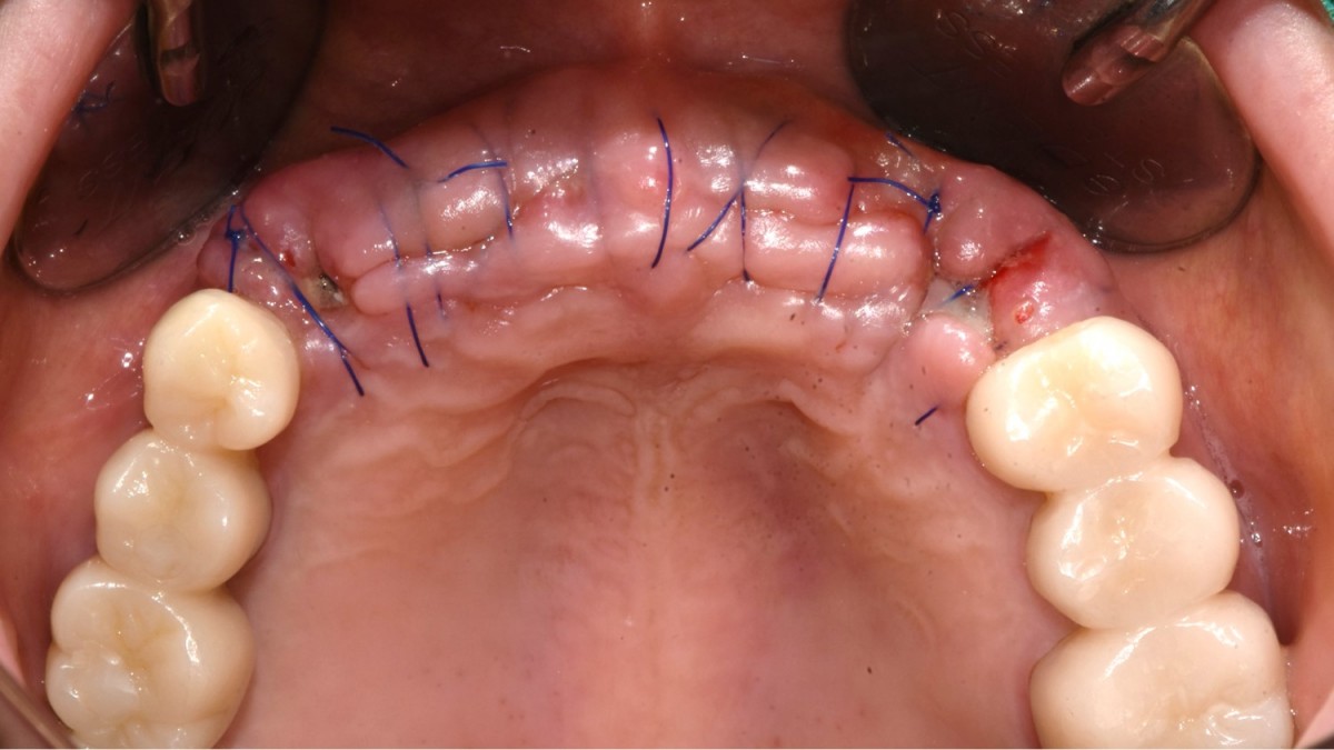 1 week post-op. HAs were connected immediately in both canine areas.