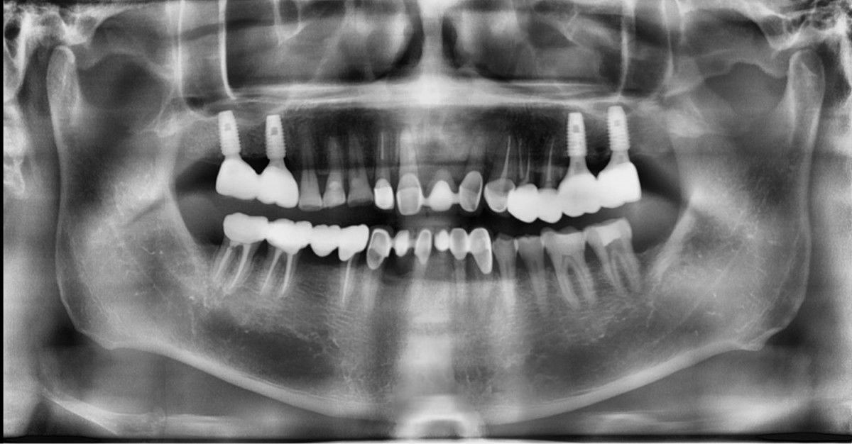 Panoramic radiograph after prosthesis delivery