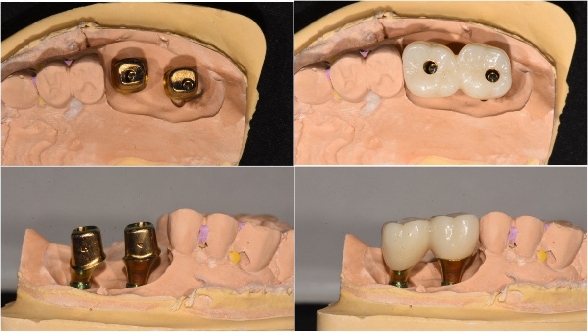 customized abutment and zirconia crown from the dental lab.