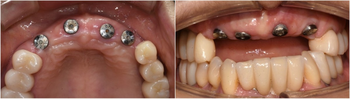 Intraoral photo on the day of impression taking.