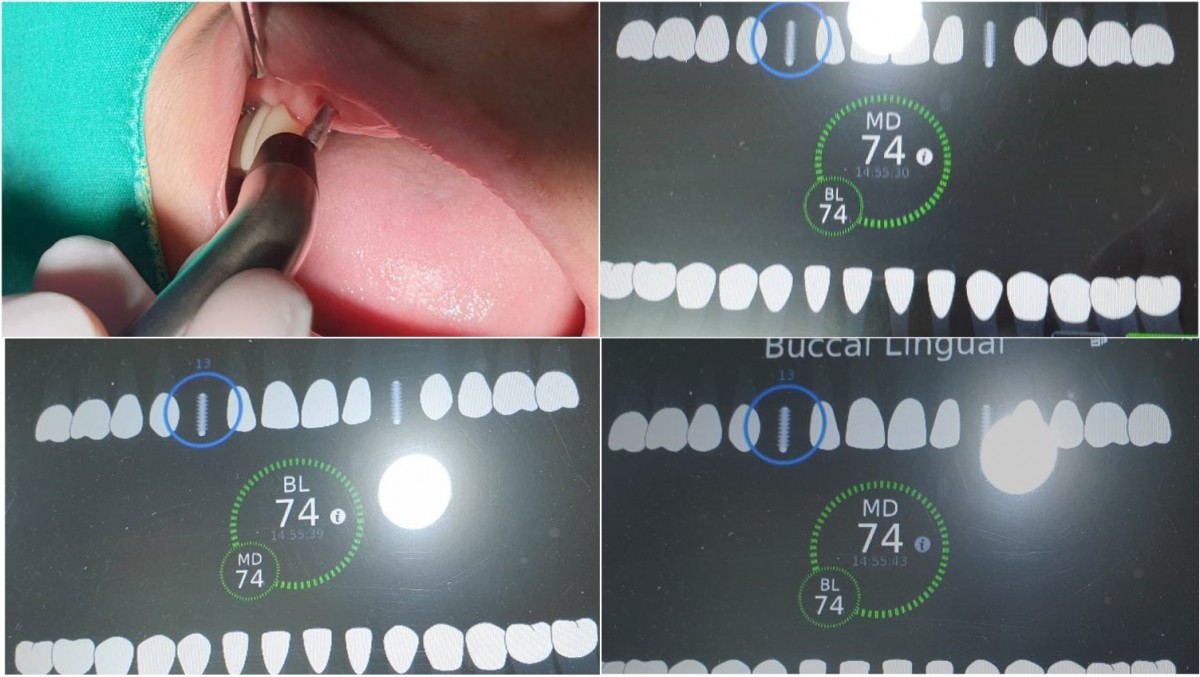 ISQ reading of right canines after 16 weeks of implant placement.