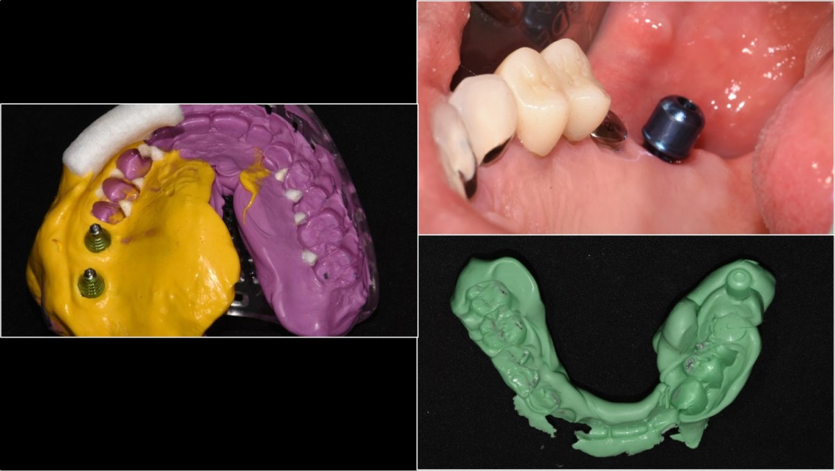 Impression taking and bite registration taking after the connection of the bite-exclusive abutment.