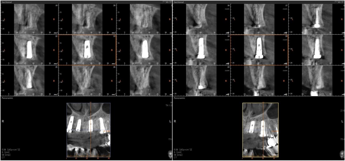 CBCT scan image focused on the central incisor and canine on the left side.