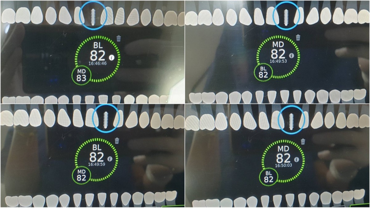 ISQ reading of the fixture in the central incisor 