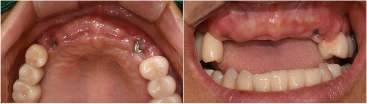 3 weeks post-op. intraoral photo before the delivery of provisional restoration