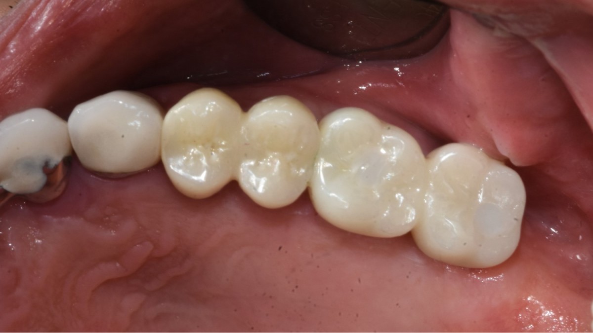 Prosthesis cementation and access hole filling