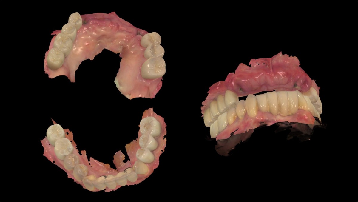 Intraoral scanning for the fabrication of provisional restorations right after suture removal 