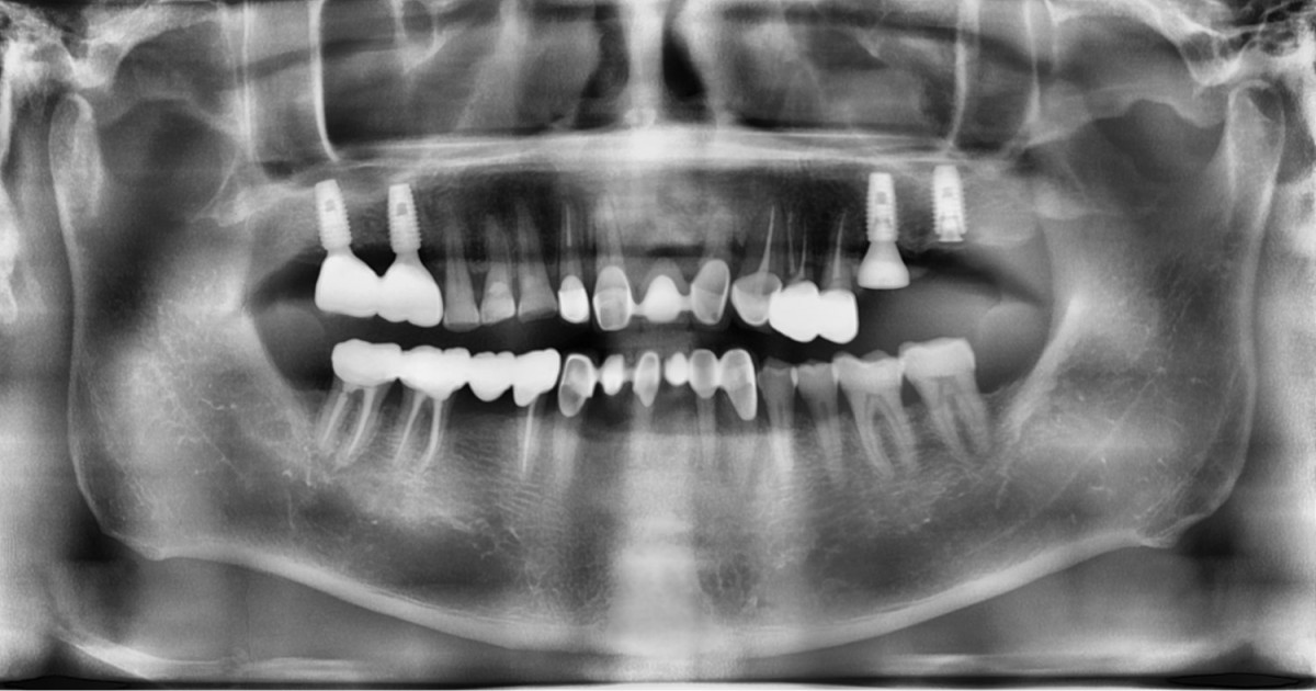 Post-op. panoramic radiograph.