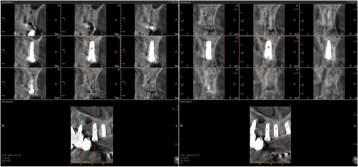 CBCT scan image focused on the canine and lateral incisor on the right side