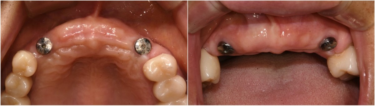 Intraoral photo before implant uncovery.