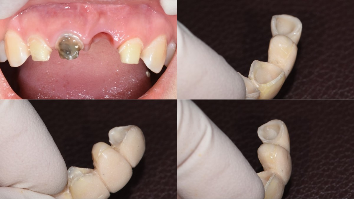 The hopeless tooth (left central incisor) was extracted and ovated pontic was cemented (about 4 weeks ago)