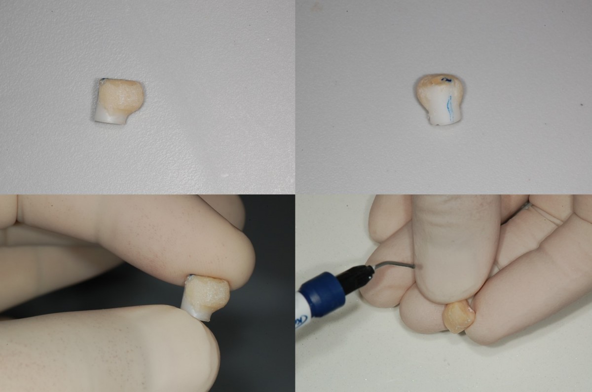 An attemp was made by adding a little flowable resin on the mesial surface of the temporary resin crown.