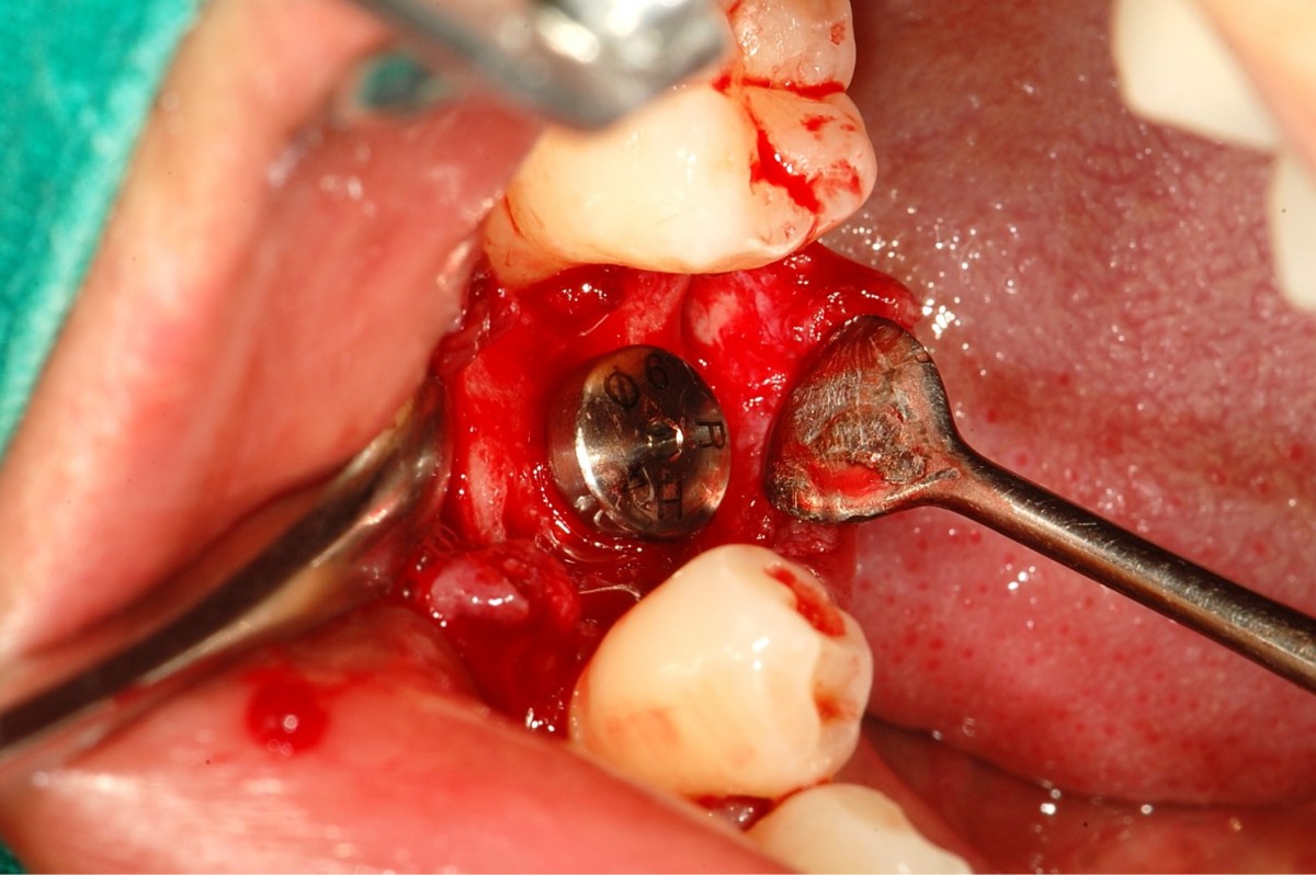 Healing abutment was connected 