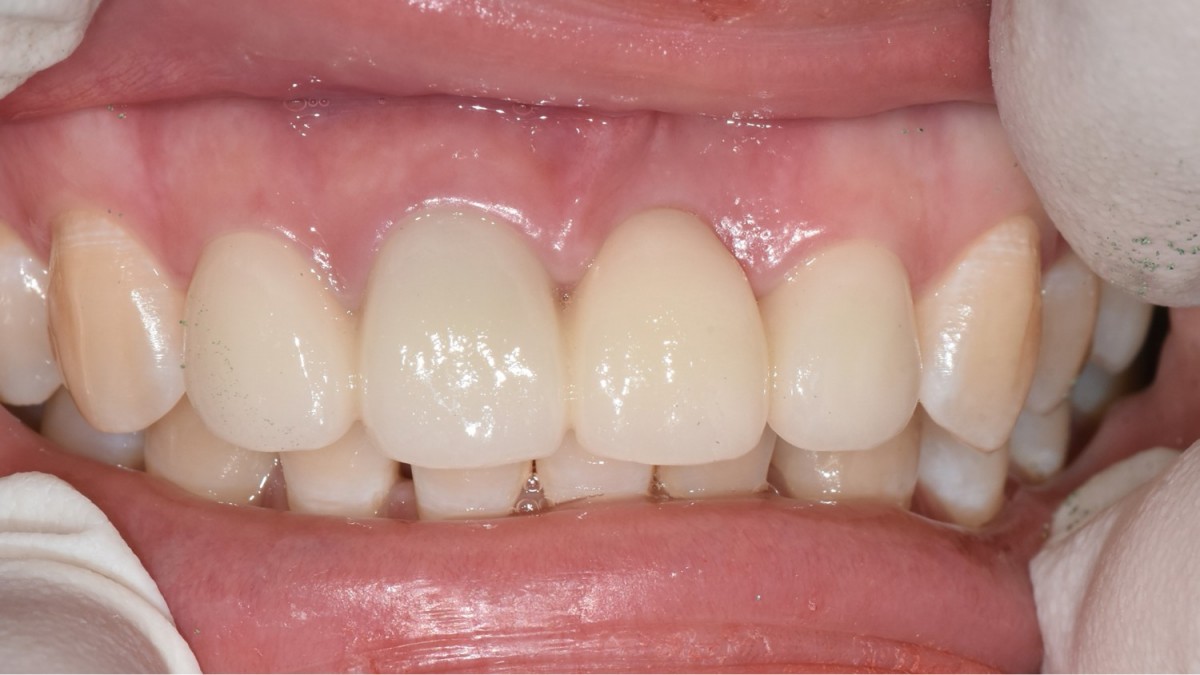 Zirconia crown and bridge.