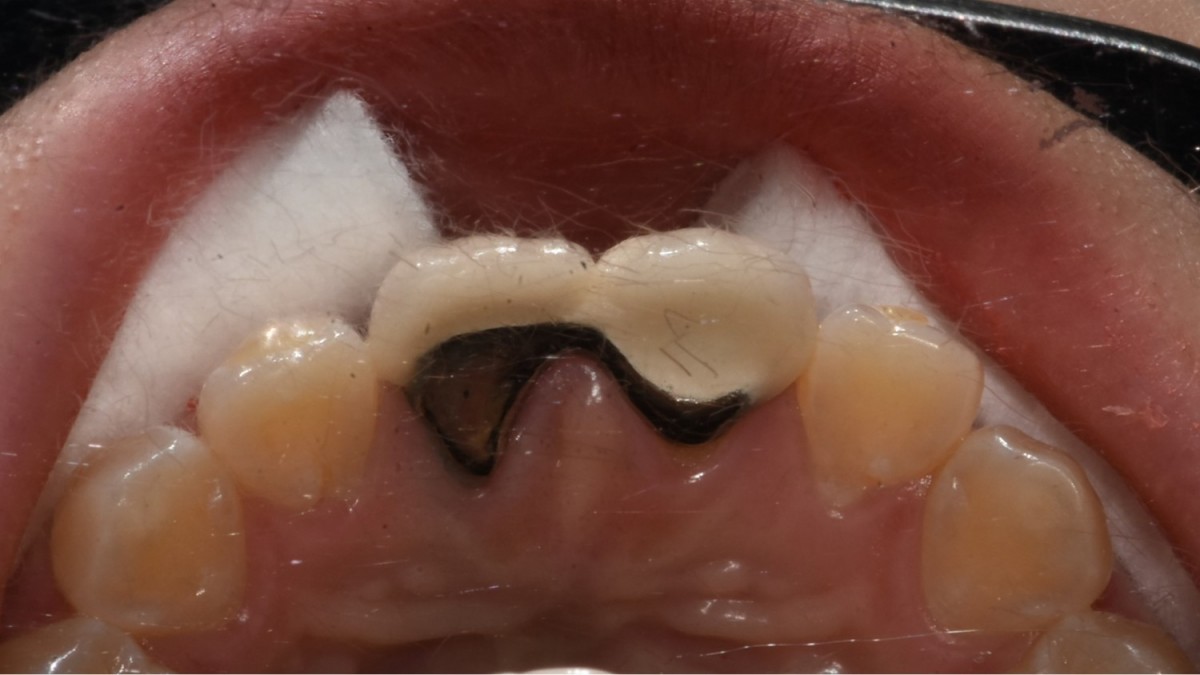 palatal view.