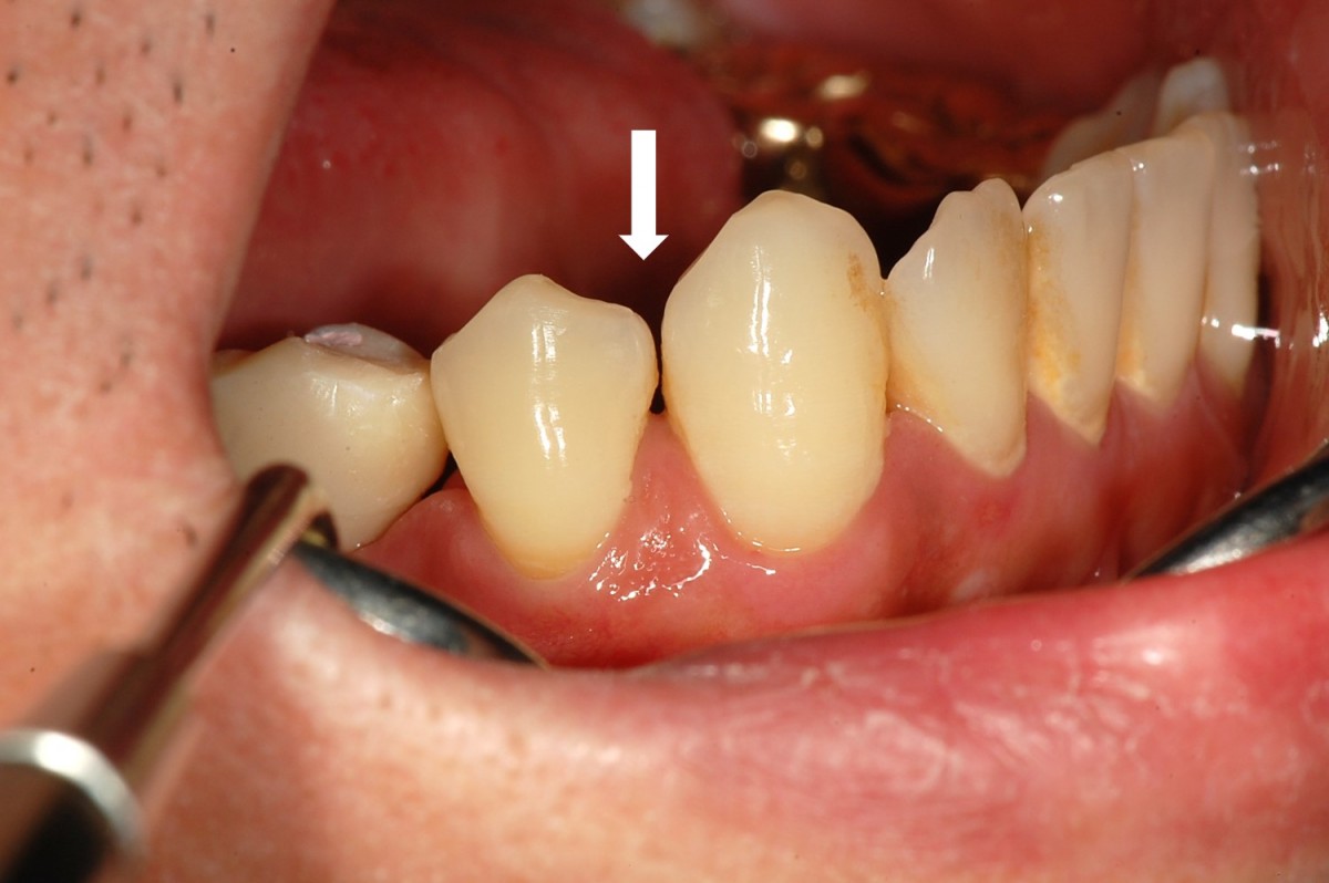 4 days later, a new temporary resin crown was cemented.