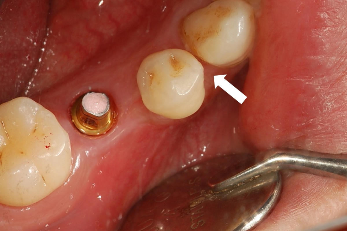 A stock abutment was connected.  The mesial contact point of the tooth in front of the implant was widened.