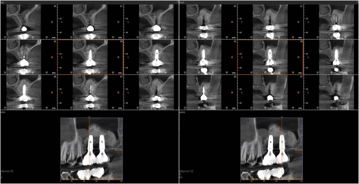 CBCT after cementation of prosthesis