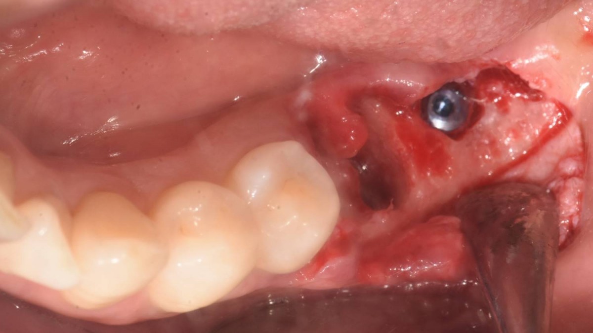 implant placement in the edentulous area. Arum Dentistry NB1 5*8.5 (10Ncm).