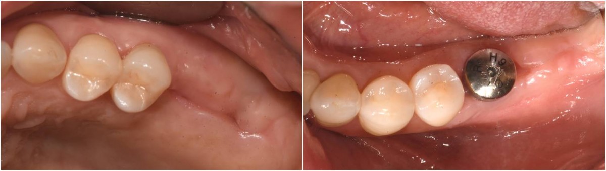 Upper ridge-4 weeks post-op. Lower ridge-7 weeks post-op.