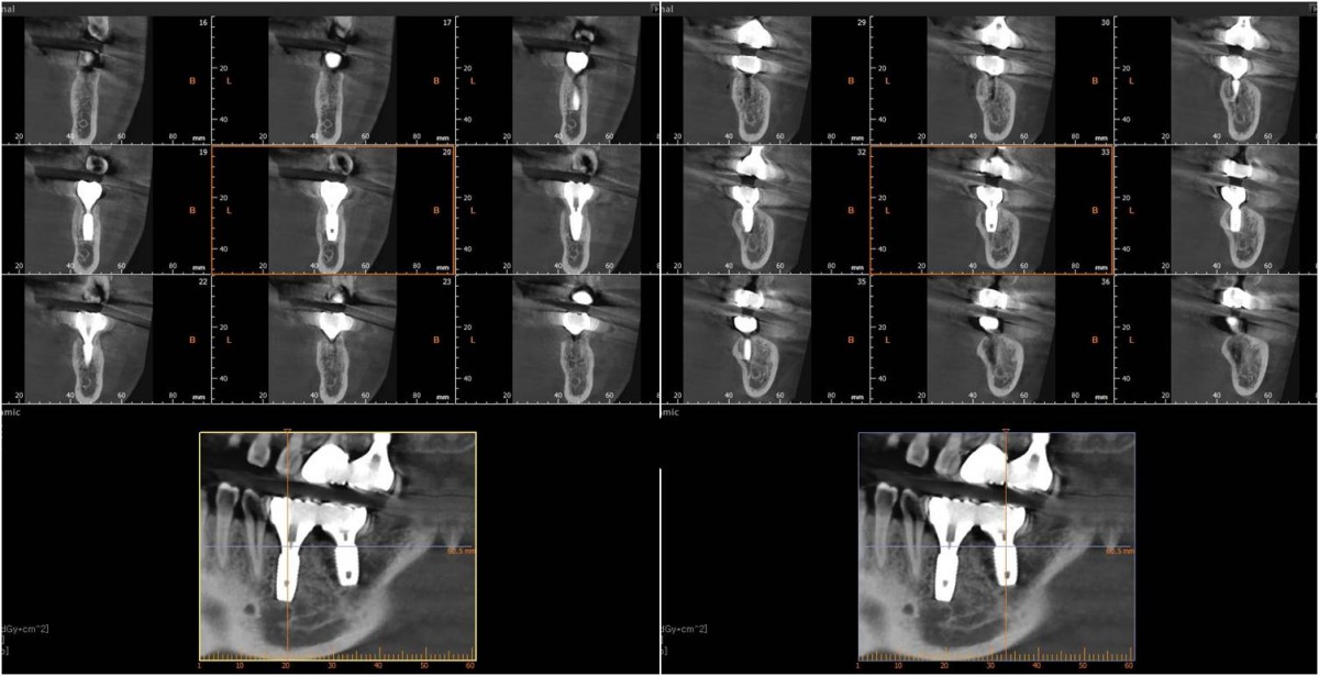 CBCT after cementation of prosthesis