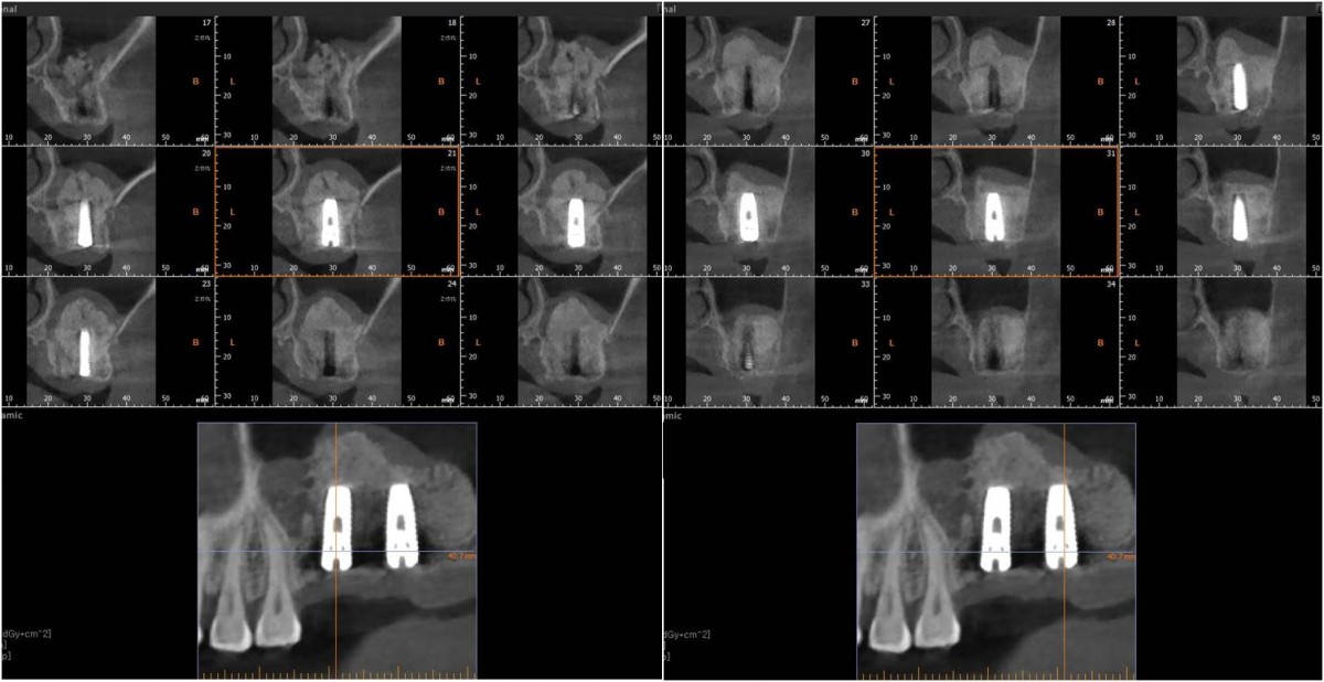 CBCT