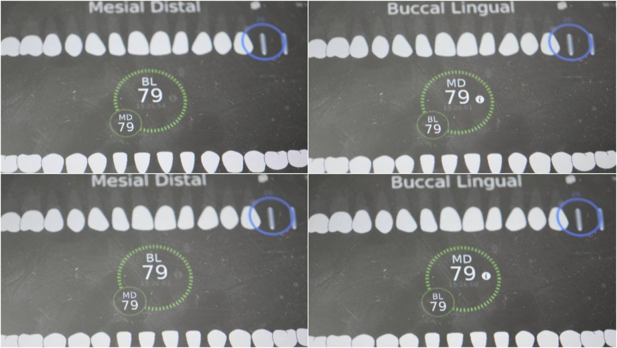 ISQ reading at the first molar zone of the maxilla.