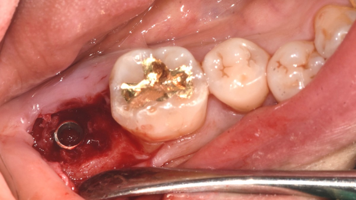 implant placement