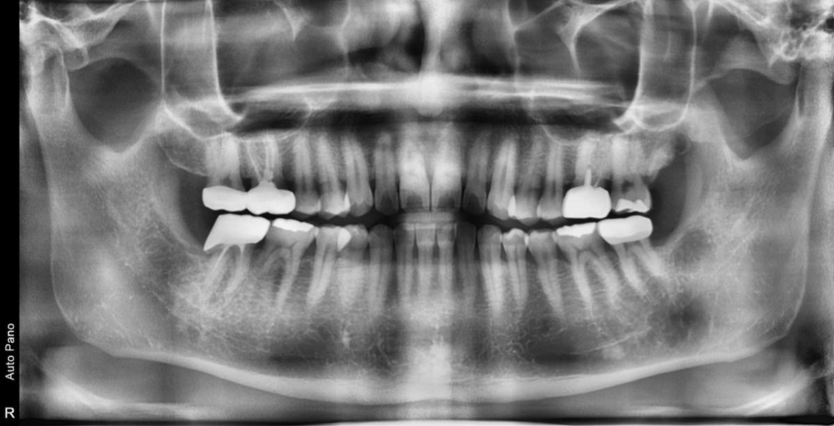 panoramic radiograph