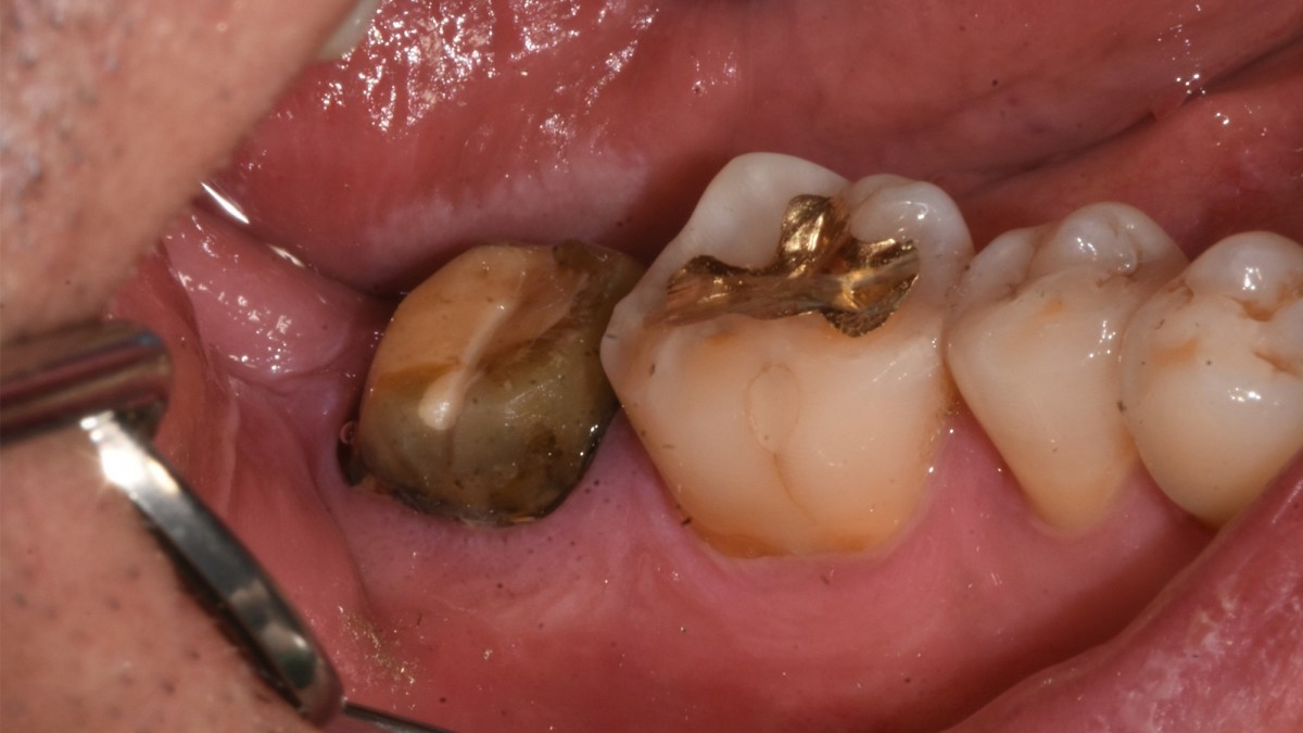old crown removal