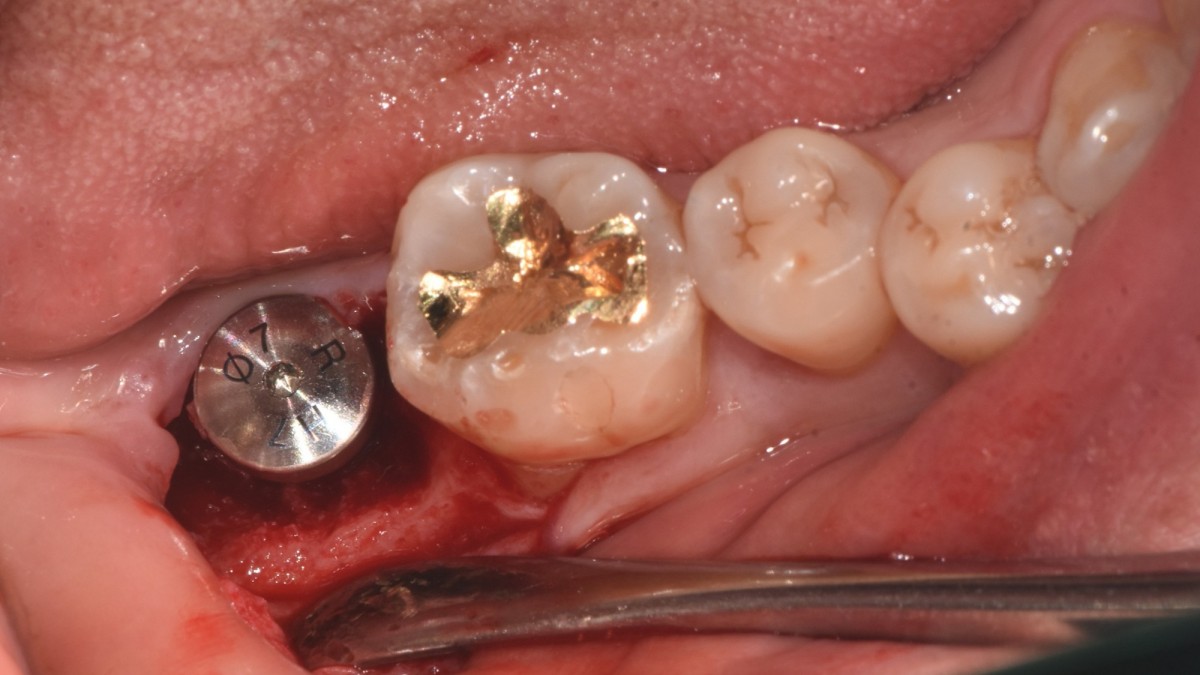 Healing Abutment connection