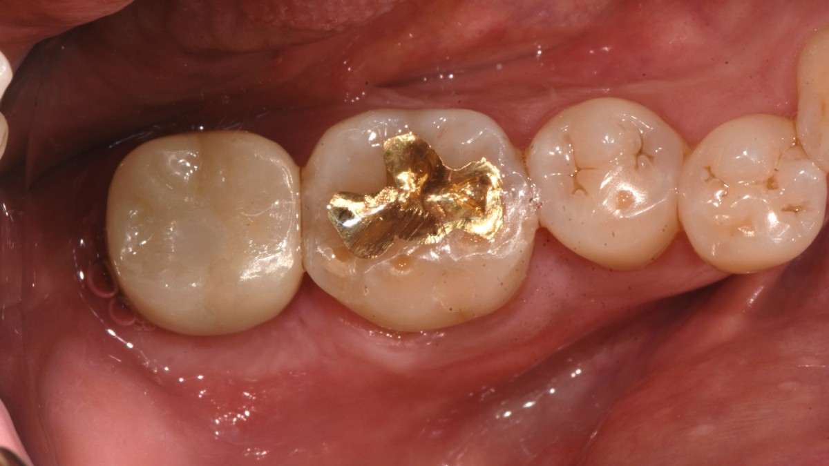 cementation (Fuji-cem) and screw hole filling